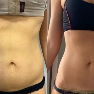 ultrasom microfocado