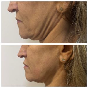 ultrasom microfocado2